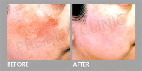 Pico Laser Treatment Acne Scar Tattoo Premier Clinic Kl Malaysia