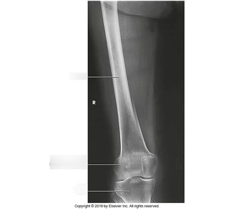 ap distal femur diagram quizlet