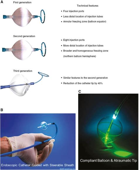 Catheter Ablation Of Atrial Fibrillation Where Are We Scienceopen