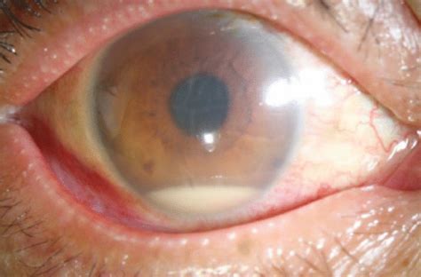 The Patient Had Conjunctival Hyperemia Corneal Edema And Hypopyon On