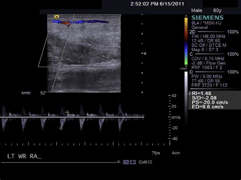 Steal Phenomenon With Diastolic Flow Reversal Is Noted At The Left