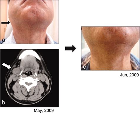 A New Category For Chronic Sclerosing Sialadenitis As An Igg4 Related