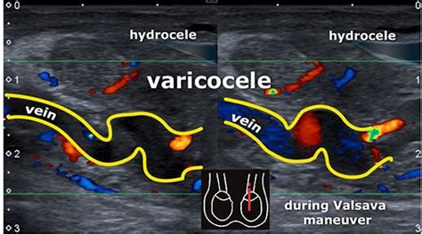 Scrotal Ultrasound Startradiology Ultrasound Medical Ultrasound