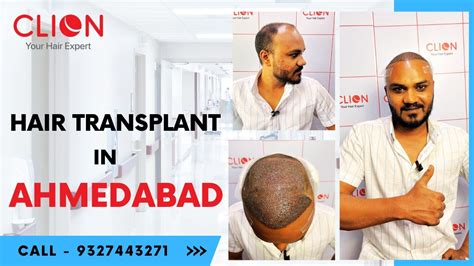 Hair Transplant In Ahmedabad Best Hair Transplant Clinic In Ahmedabad