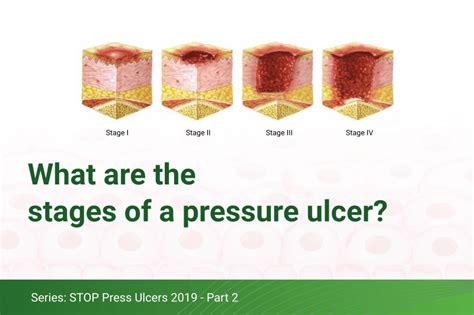 What are the stages of a pressure ulcer? - O Neill Healthcare