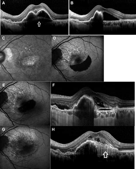 Retinal Pigment Epithelium Tears Classification Pathogenesis