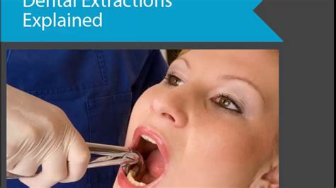 Dental Extractions Explained Youtube