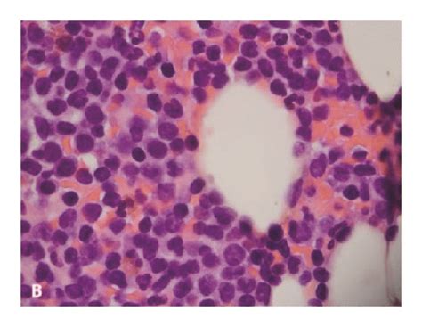 T Pll In Bone Marrow Biopsy Specimen A Bone Marrow Clot Section Shows