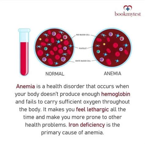 Iron Deficiency Anemia - Bookmytest