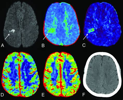Lacunar Stroke