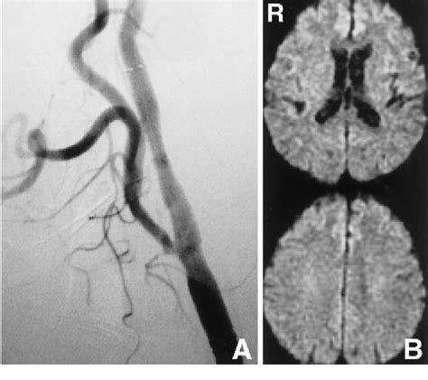 Case 1 A Postprocedural Angiogram Of The Left Common Carotid Artery