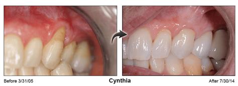 Gum Recession Treatment With Pinhole Surgical Technique Pst™ North