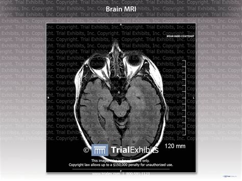 Brain Mri Axial View With Measurement Trialquest Inc