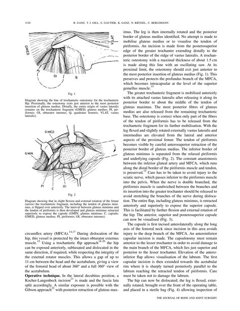 SOLUTION: Ganz surgical dislocation of the adult hip technique with ...