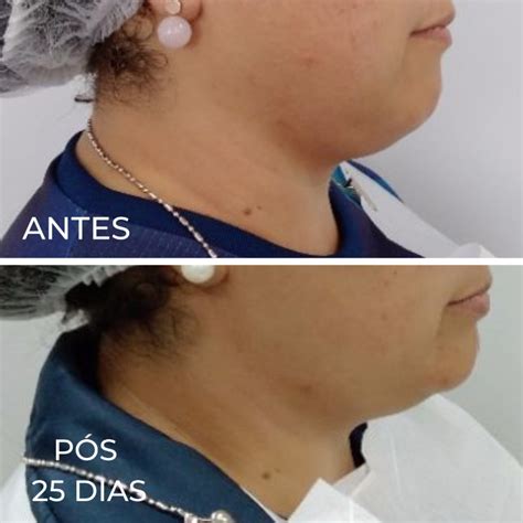 Quanto Tempo A Pele Cola Depois Da Lipo De Papada - Lipo de de Papada - Royal Face | Clínica de Estética Facial