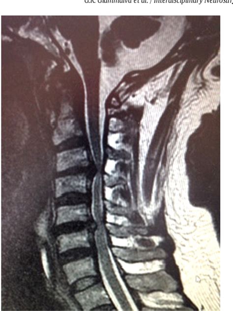 Figure From White Cord Syndrome After Non Contiguous Double Level