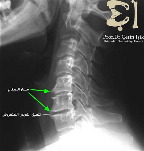 Neck beak disease and its problems - Dr. What's wrong with you?