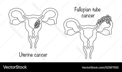 Uterine Cancer Fallopian Tube Royalty Free Vector Image