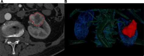 Frontiers Radiomics Analysis Of Contrast Enhanced Ct Scans Can