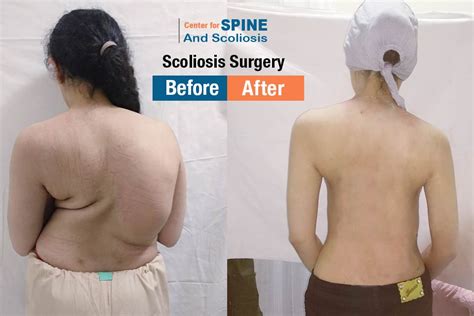 Severe Scoliosis Before And After