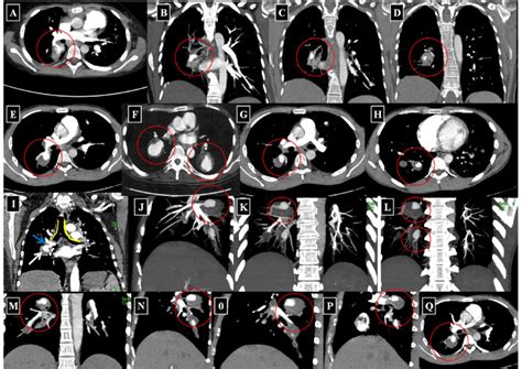 Examples Of Variable Sized Pulmonary Artery Pseudoaneurysms PAP