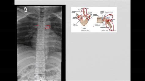 Lateral Thoracic Spine