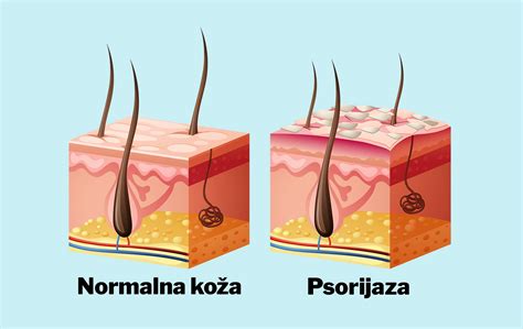 Psorijaza često nosi rizik od pojave kardiovaskularnih bolesti - eKlinika