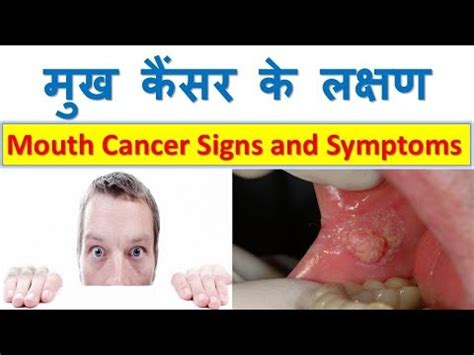 Lips Cancer Symptoms In Hindi Lipstutorial Org