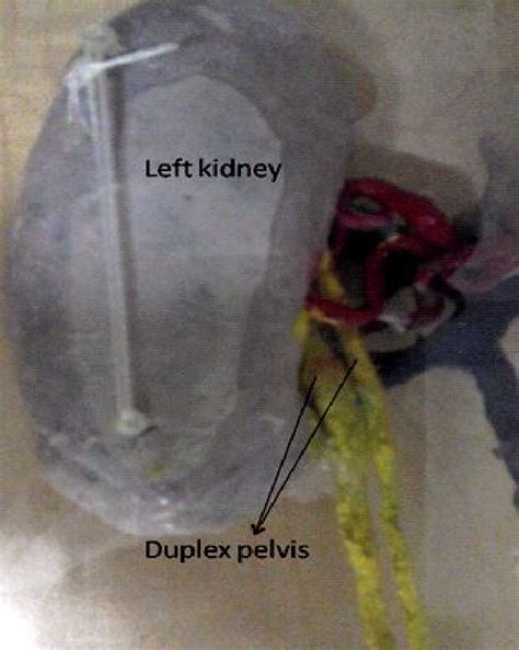 left kidney showing duplex pelvis[ left kidney posterior view] | Download Scientific Diagram