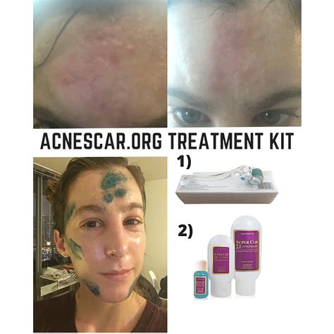 Acne Scars Indented Atrophic Rolling Pitted Deep Heal Remove Etsy