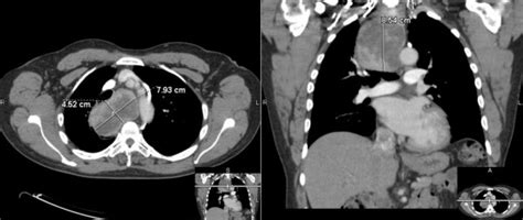 Ct Of The Chest Revealing A Posterior Mediastinal Mass That Extends All