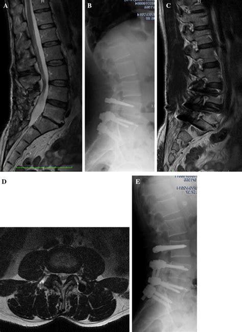 A Case Male Years Old Preoperative Mri Severe Ddd At L S And