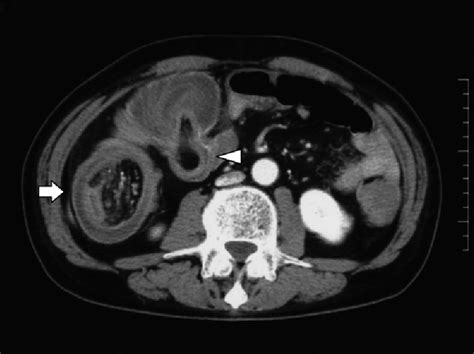 Figure 1 From Adult Intussusception Caused By An Inverted Meckel Diverticulum Semantic Scholar