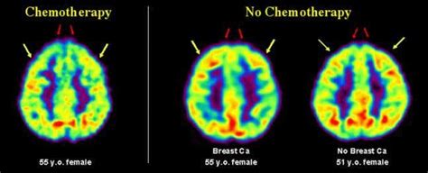 Chemotherapy Linked To Lasting Brain Change New Scientist