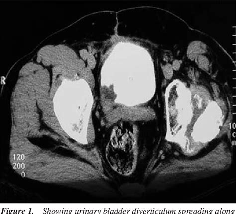 Figure 1 From Mucinous Adenocarcinoma Of The Urinary Bladder After Long