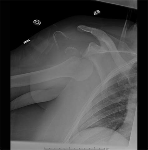 20 Shoulder Dislocation Musculoskeletal Key