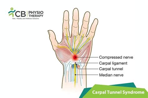 Top Exercises For Carpal Tunnel Syndrome Cts Webp