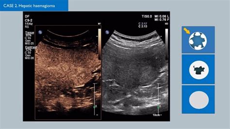 CEUS Contrast Enhanced Ultrasound Philips Healthcare