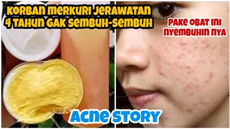 Korban Merkuri 4 Tahun Jerawatan Sembuh Pake Obat Jerawat Ini Cara