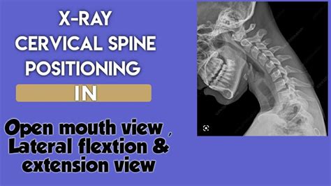 Open Mouth Cervical Spine X Ray Lateral Flexion And Extension Lateral Flexion And Extension