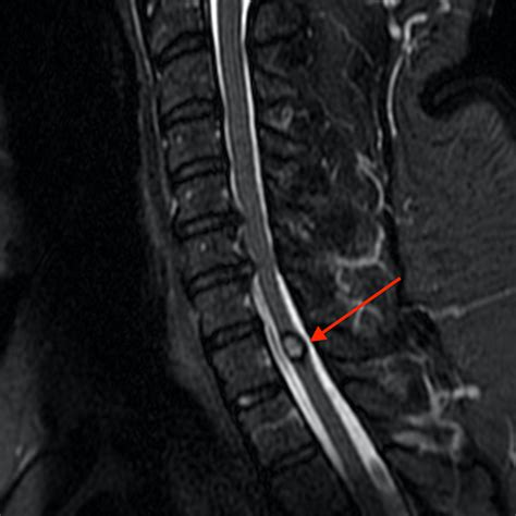 Acromial Stress Fractures After Shoulder Decompression Surgery | Radsource