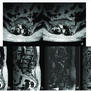 Axial T2 A And Sagittal T2 B T1 C T2 FS D MRI Demonstrate A