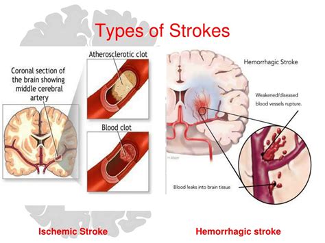 Ppt Care Of The Stroke Patient Improving Patient Outcomes Powerpoint