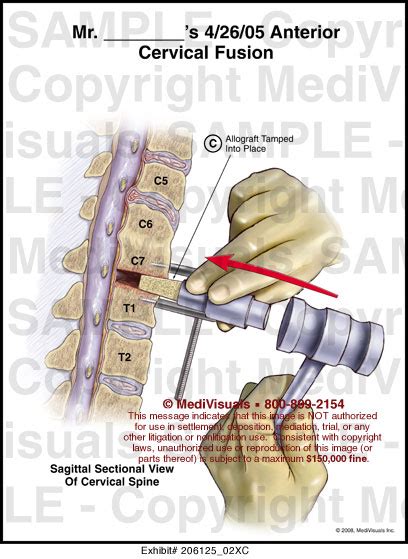 Anterior Cervical Fusion Medical Illustration Medivisuals