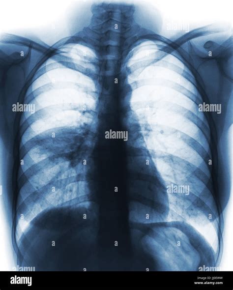 Pneumonia Film Chest X Ray Show Alveolar Infiltrate At Right Middle