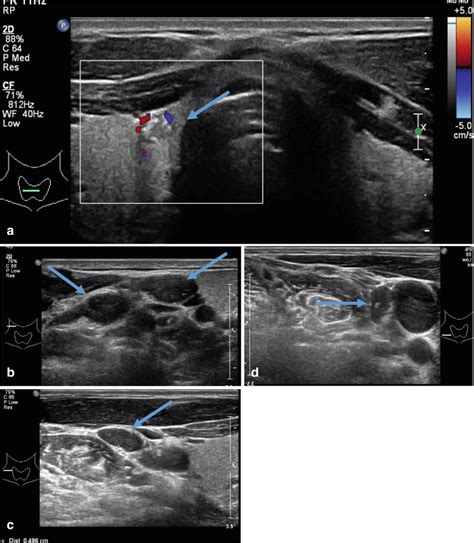 Isthmus Thyroid Ultrasound