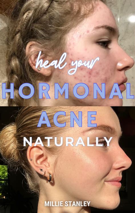 Heal Hormonal Acne E Book Life With Mils