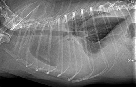 Aproximación Diagnóstica Al Paciente Con Efusión Pleural Criterios De