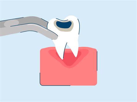 Tooth Extraction Procedure Aftercare And Recovery