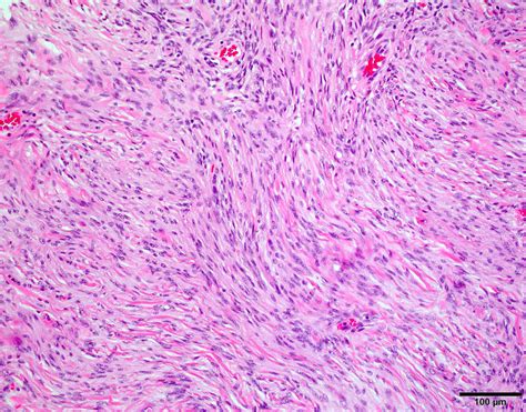 Meningioma Histology